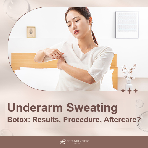 Underarm Sweating (Hyperhidrosis): How Long Does Botox Last?