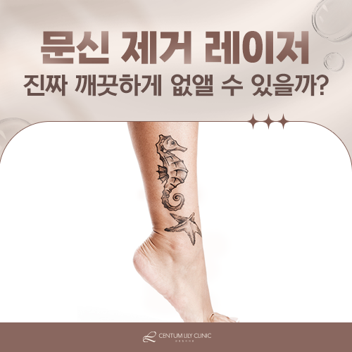 문신 제거, 흉터 없이 지우려면 무엇을 확인해야 할까?