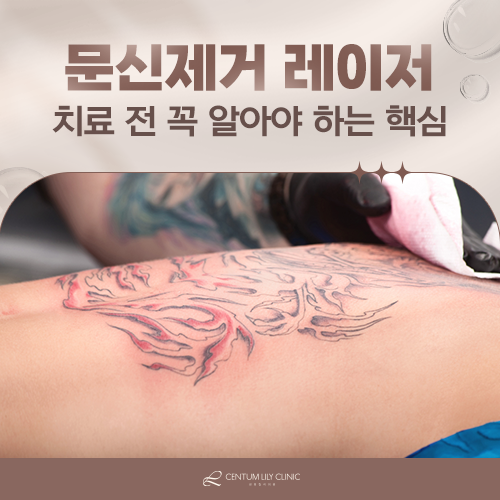 문신제거 후 흉터, 왜 생기는 걸까요?